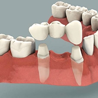 Implanturi dentare